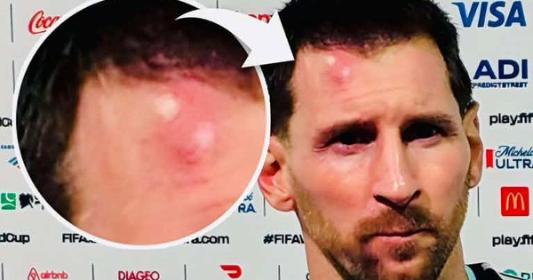 Messi sưng vêu trán sau trận thắng Cabo Verde: Vì sao nên nỗi? - hình ảnh - jun88play.vip Messi sưng vêu trán sau trận thắng Cabo Verde: Vì sao nên nỗi? - hình ảnh - jun88play.vip